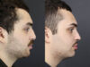 Rhinoplasty case #11419 slider thumbnail