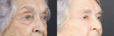 Lower Blepharoplasty case #11451