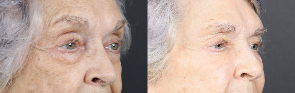 Lower Blepharoplasty case #11451