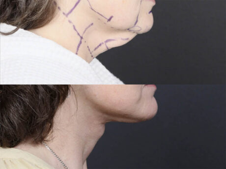 C02 Laser case #11644