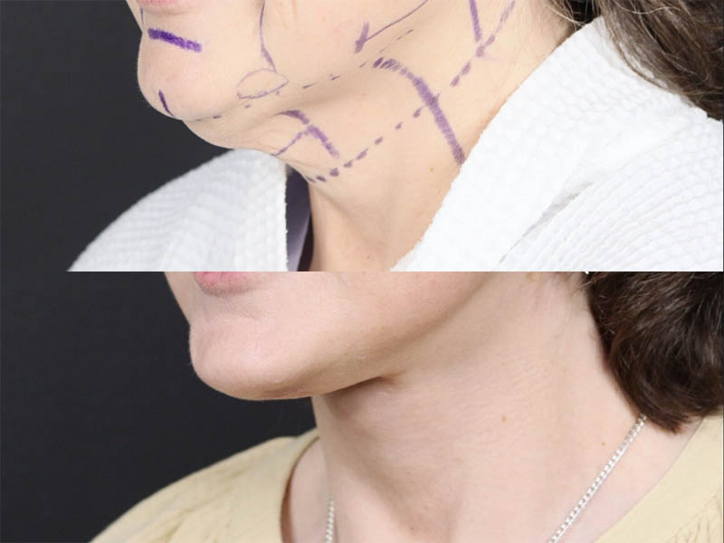 C02 Laser case #11644