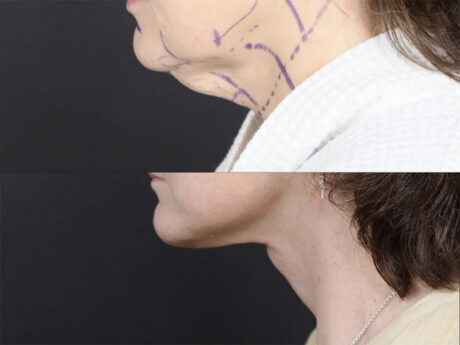 C02 Laser case #11644