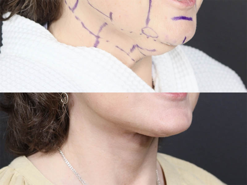 C02 Laser case #11644