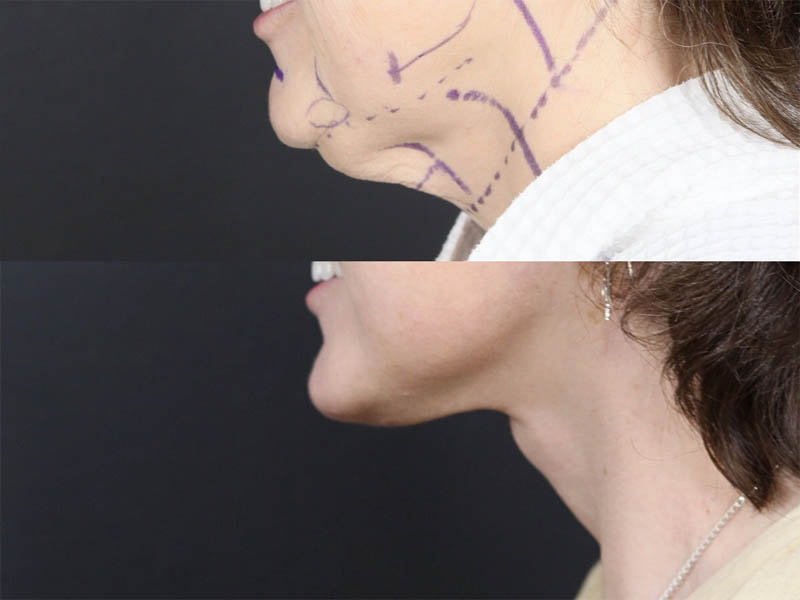 C02 Laser case #11644