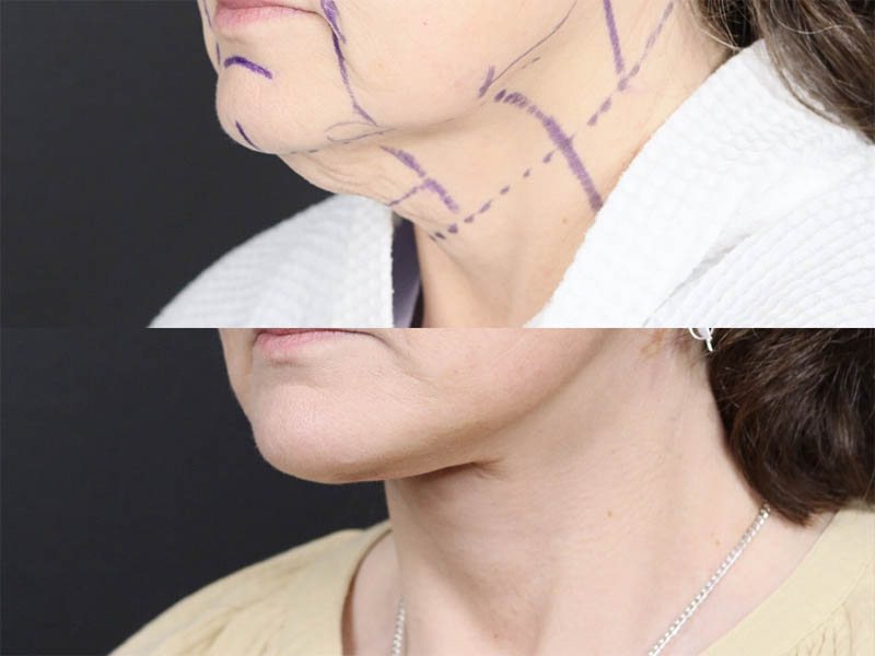 C02 Laser case #11644