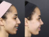 Rhinoplasty case #11566 slider thumbnail