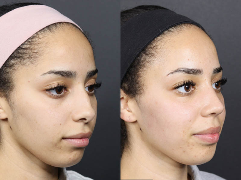Rhinoplasty case #11566