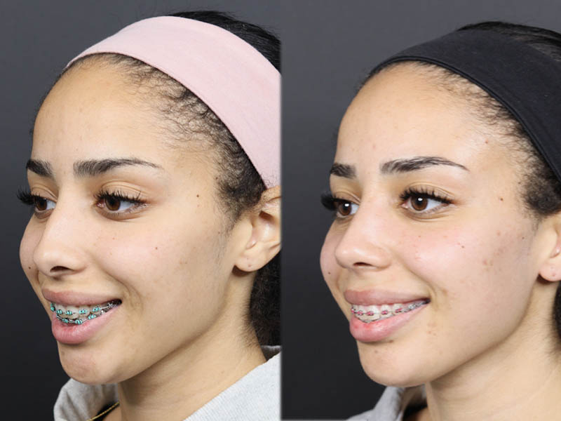 Rhinoplasty case #11566