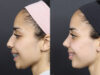Rhinoplasty case #11566 slider thumbnail