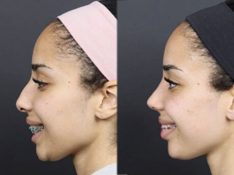 Rhinoplasty case #11566