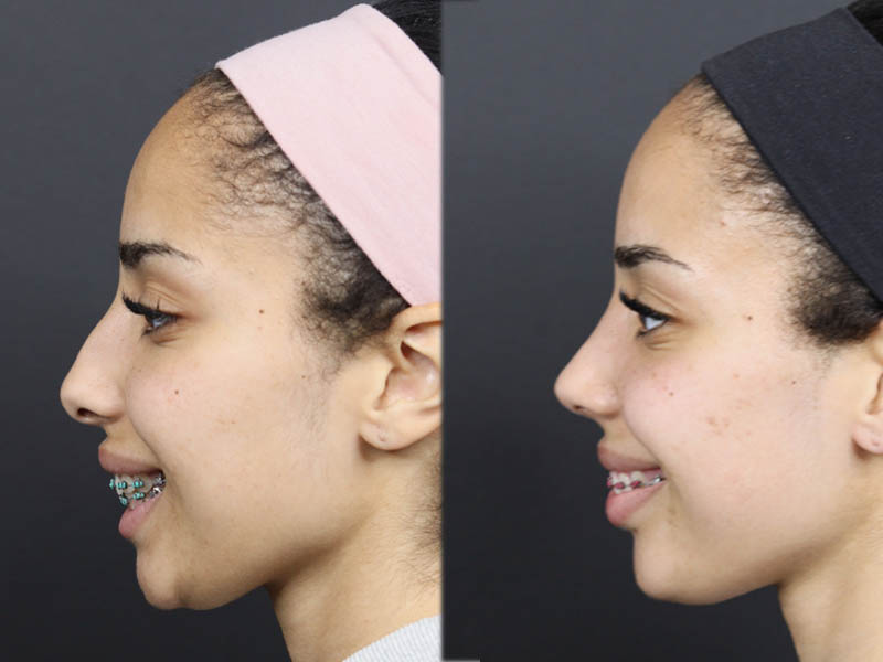 Rhinoplasty case #11566