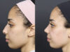 Rhinoplasty case #11566 slider thumbnail