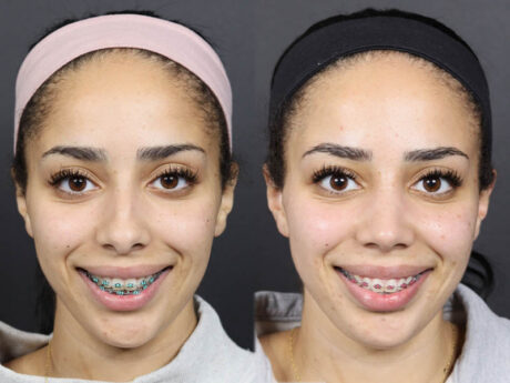 Rhinoplasty case #11566