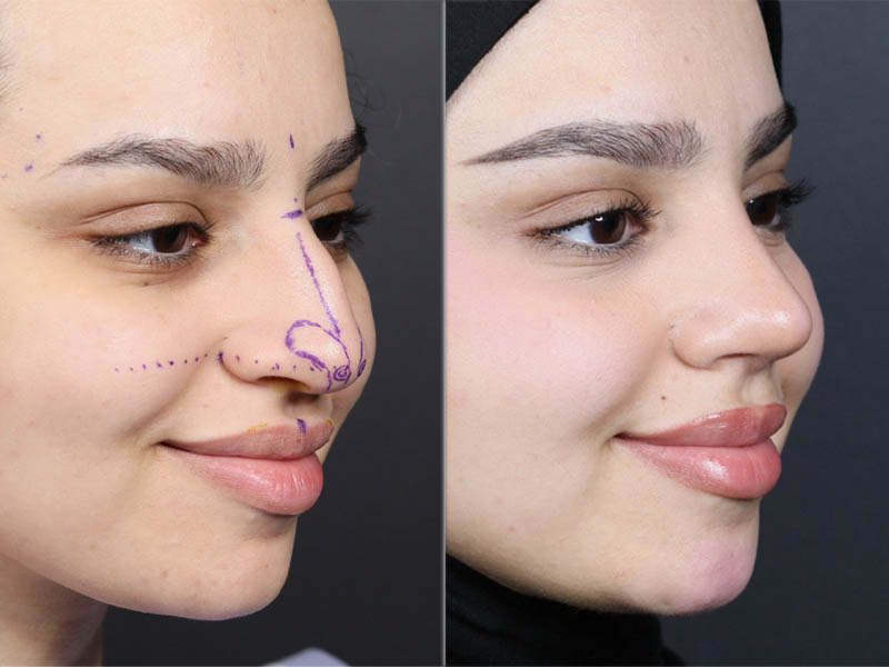 Rhinoplasty case #11573