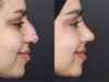 Rhinoplasty case #11573 slider thumbnail