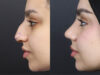 Rhinoplasty case #11573 slider thumbnail