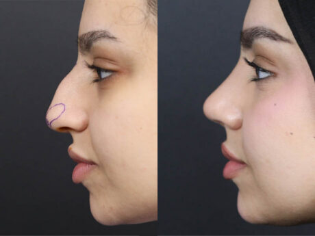 Rhinoplasty case #11573
