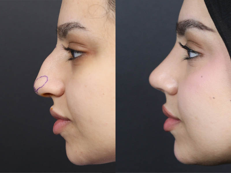 Rhinoplasty case #11573