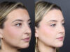 Rhinoplasty case #11579 slider thumbnail