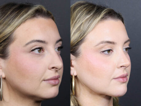 Rhinoplasty case #11579