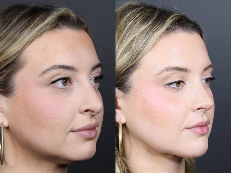 Liposuction case #11588