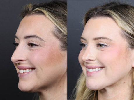 Rhinoplasty case #11579