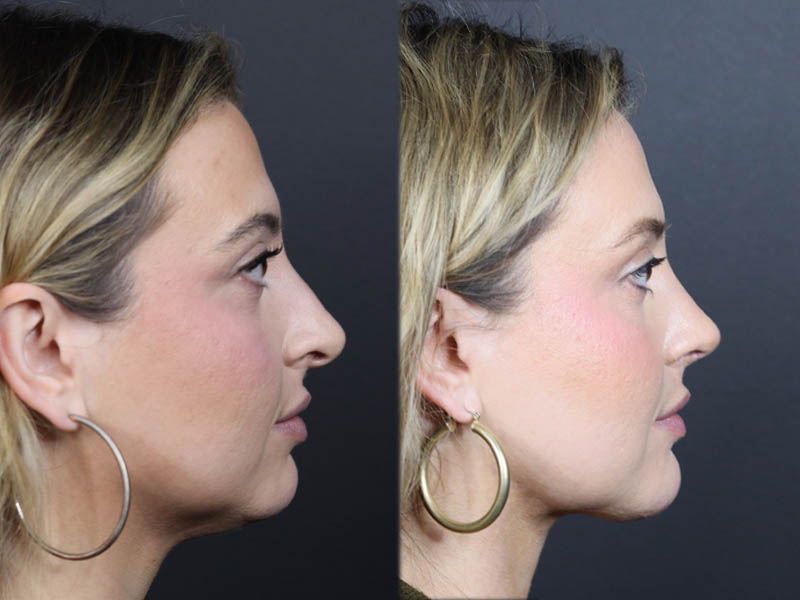 Liposuction case #11588