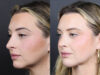 Rhinoplasty case #11579 slider thumbnail