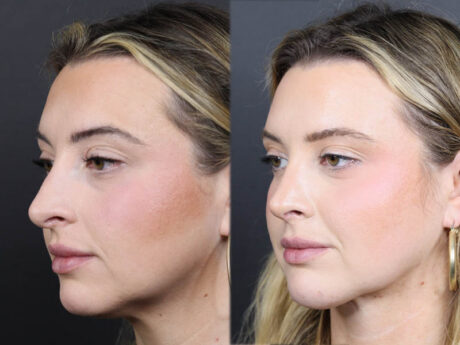 Rhinoplasty case #11579