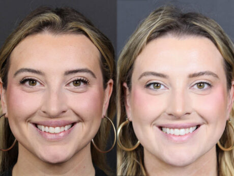 Rhinoplasty case #11579