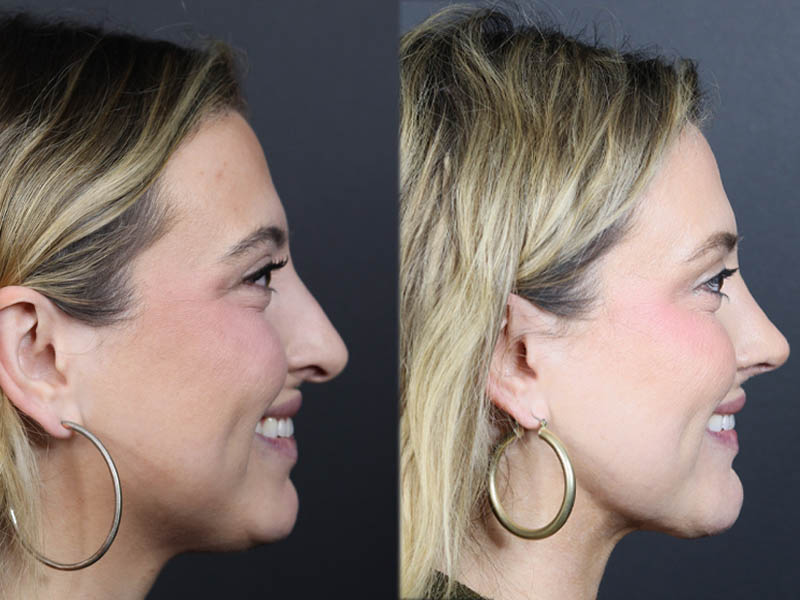 Liposuction case #11588