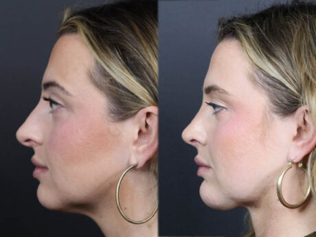 Rhinoplasty case #11579