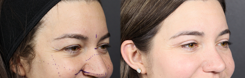 Upper Blepharoplasty case #11549