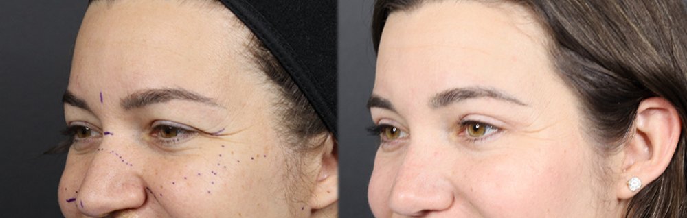 Upper Blepharoplasty case #11549