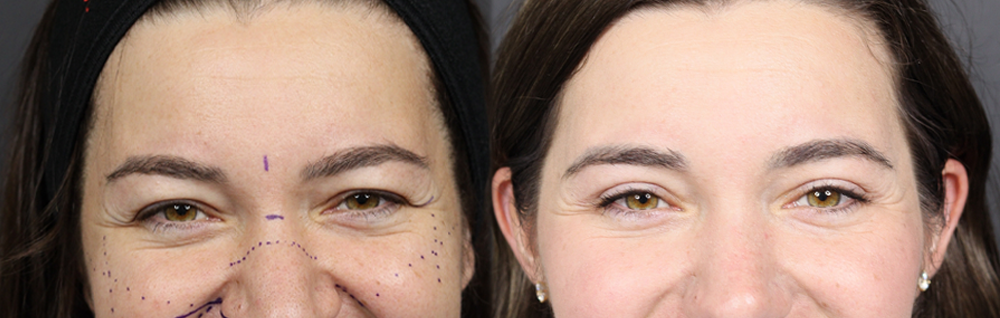 Upper Blepharoplasty case #11549