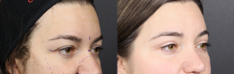 Upper Blepharoplasty case #11549