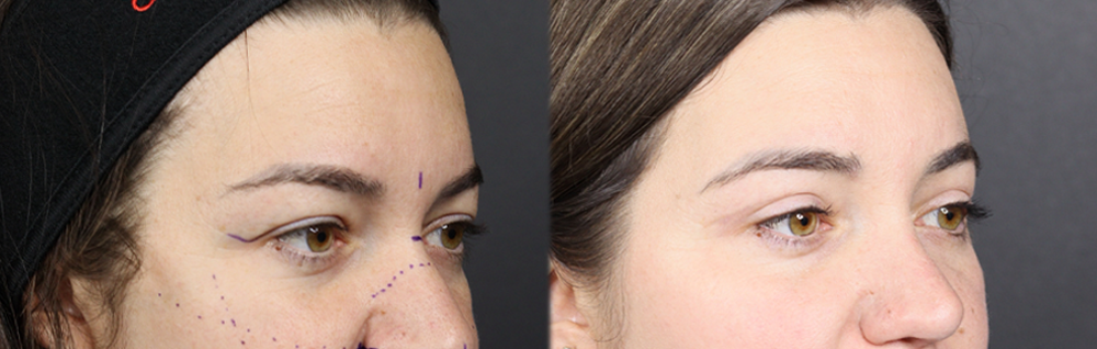 Upper Blepharoplasty case #11549
