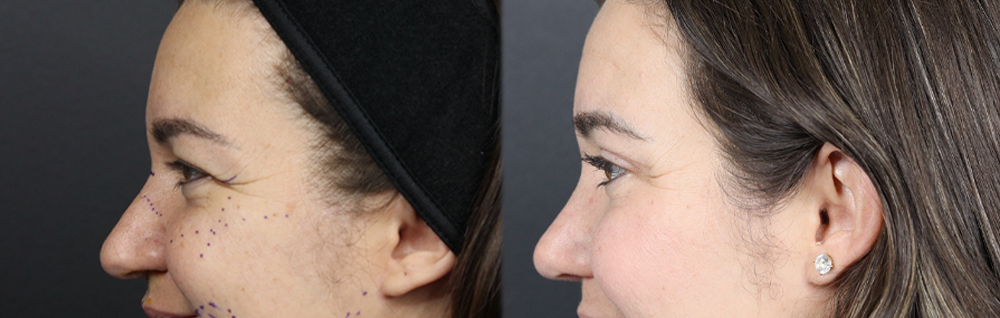 Upper Blepharoplasty case #11549