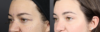 Upper Blepharoplasty case #11549 slider thumbnail
