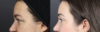 Upper Blepharoplasty case #11549 slider thumbnail