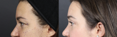 Upper Blepharoplasty case #11549