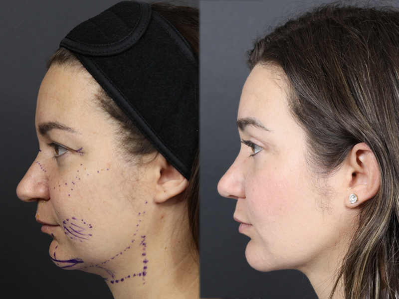 Rhinoplasty case #11558
