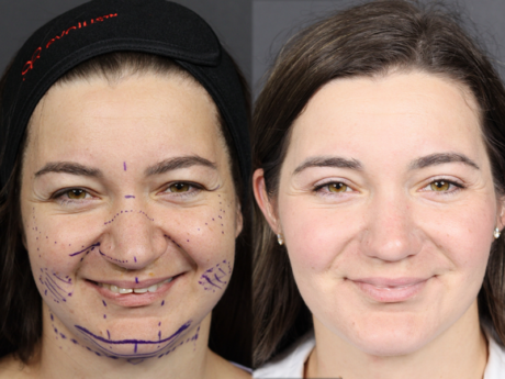 Rhinoplasty case #11558