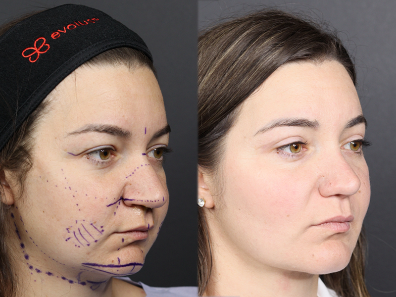 Rhinoplasty case #11558