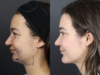 Rhinoplasty case #11558 slider thumbnail