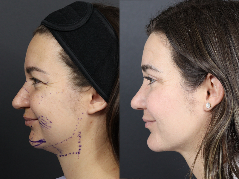 Rhinoplasty case #11558