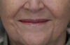 Lip Lift case #11784