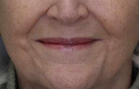 Lip Lift case #11784
