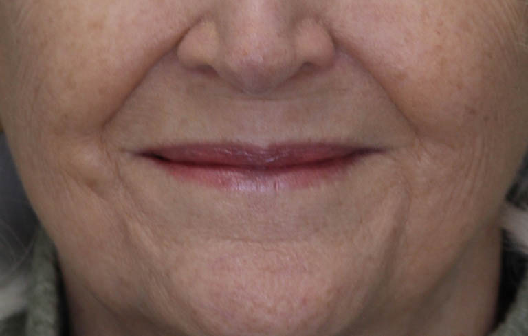 Lip Lift case #11784