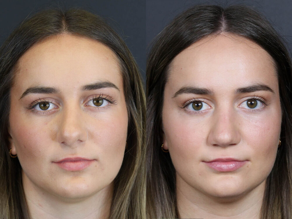 Revision Rhinoplasty case #11743